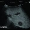 US-8_Pediatric_FAST_Appendicitis-resampled-named.jpg
